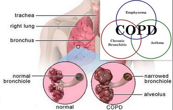 Bệnh phổi tắc nghẽn mạn tính COPD là gì?